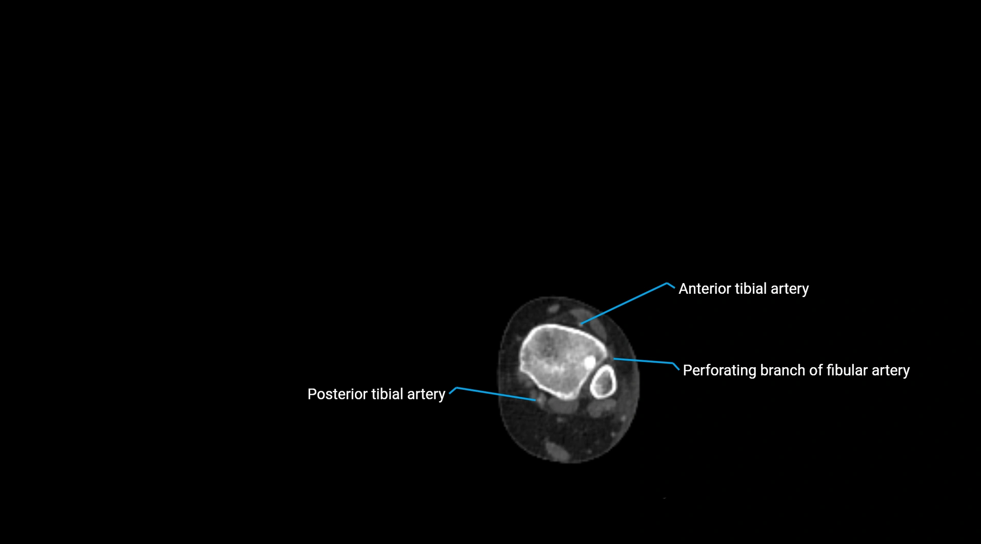 CTA lower limb cross sectional anatomy labelled image _270.webp